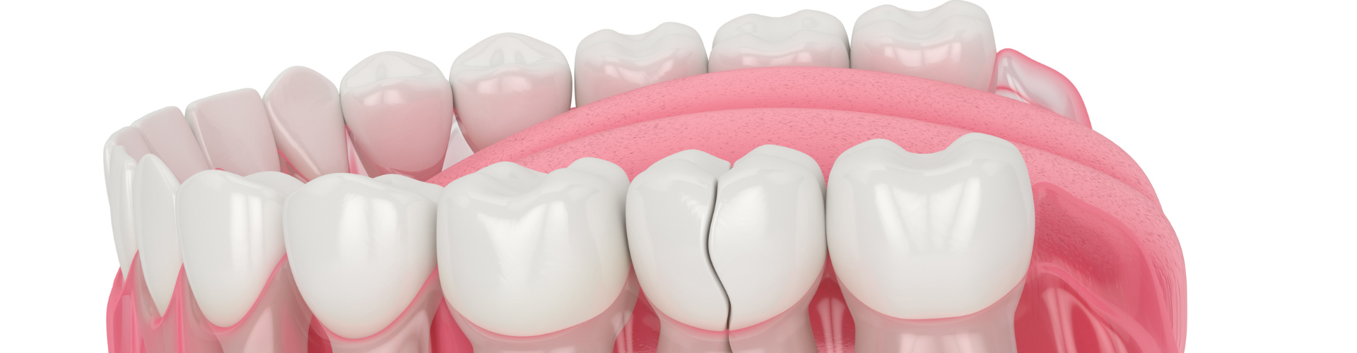 3D render of a lower denture showing the penultimate molar with a crack.